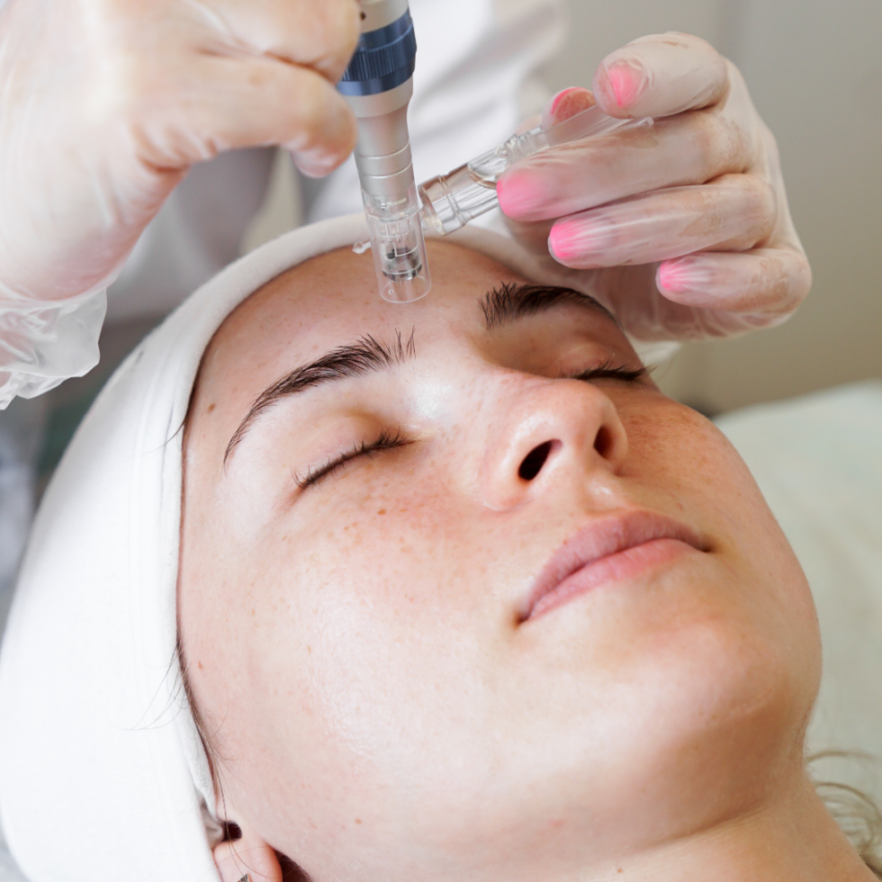 Lady getting microneedling at divine medspa | Ormond Beach