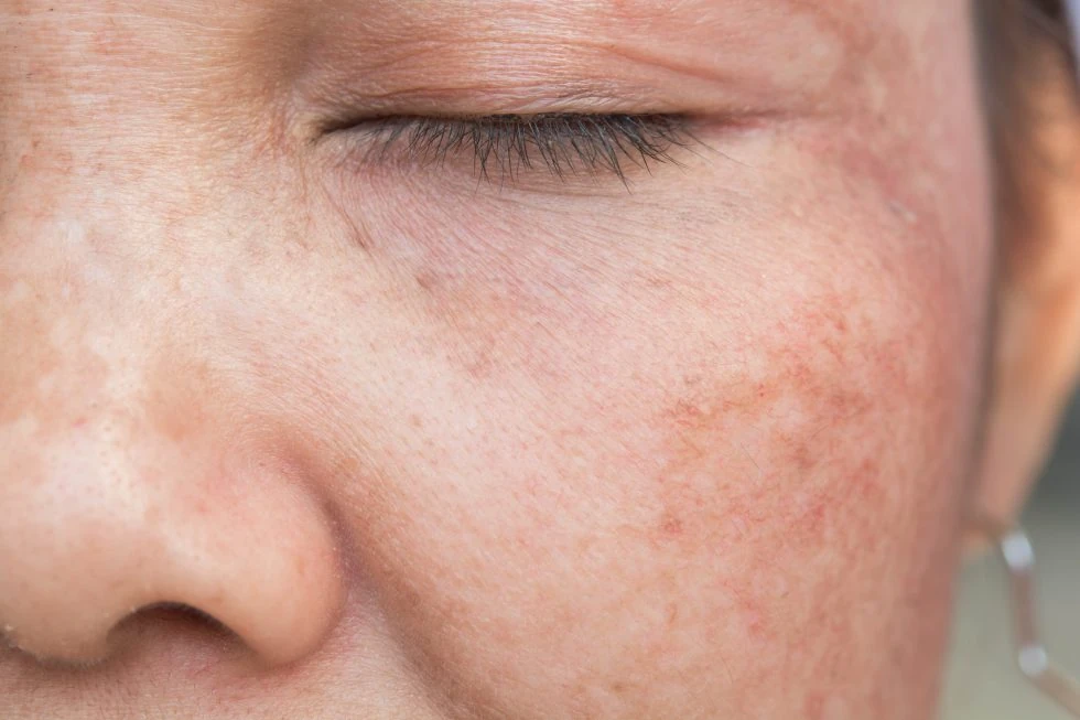 Lady with Rosacea seeking treatment | Divine MedSpa | Ormond Beach