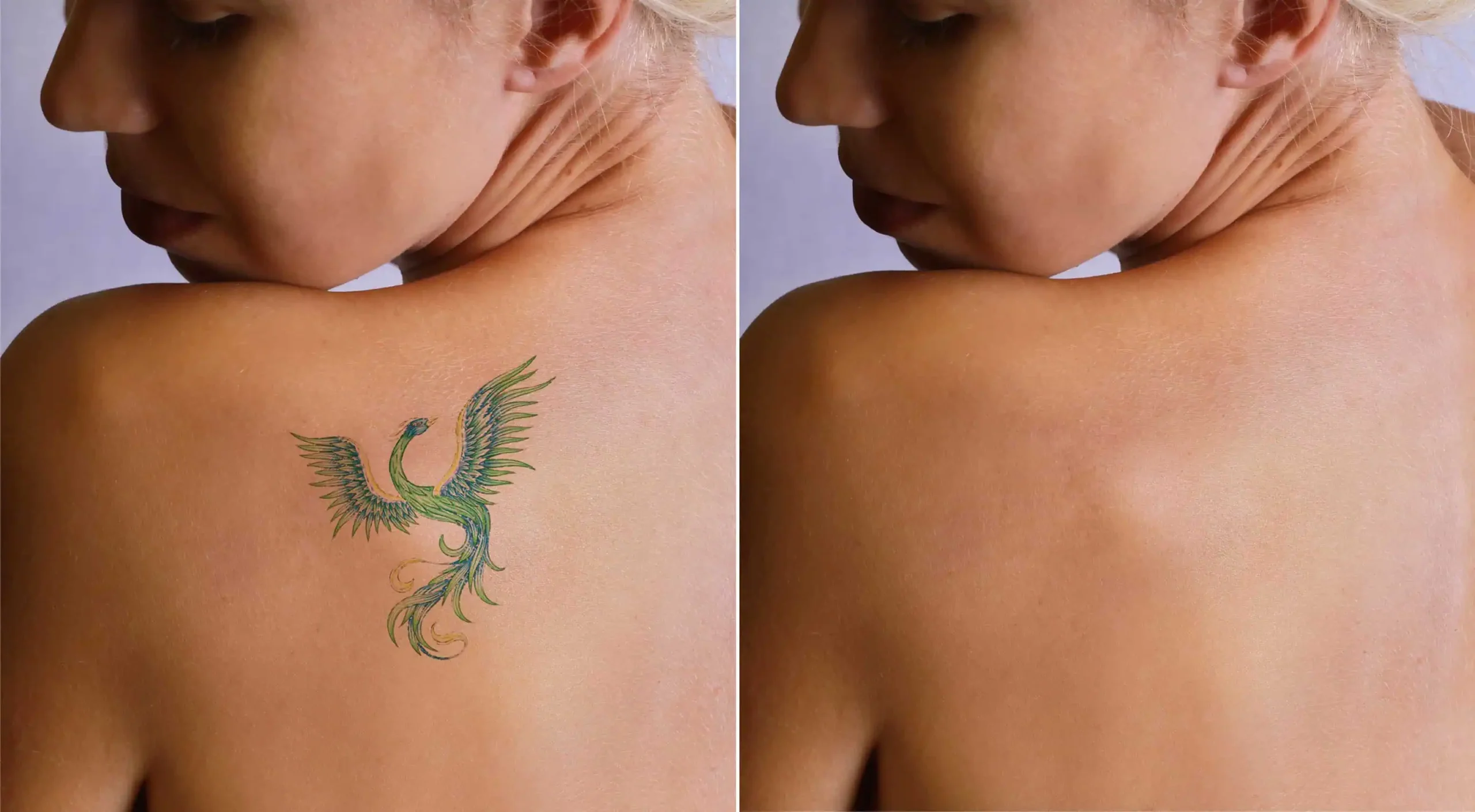 Laser Tattoo Removal at Divine MedSpa | Ormond Beach, FL