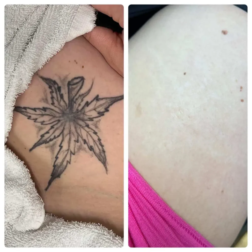 Forearm tattoo removal before & after showing faded ink and clearer skin after treatment
