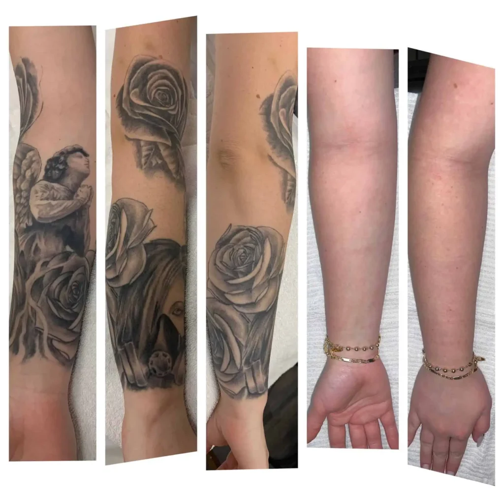 Hand tattoo removal before & after — original ink largely faded and skin appears clearer post-treatment.