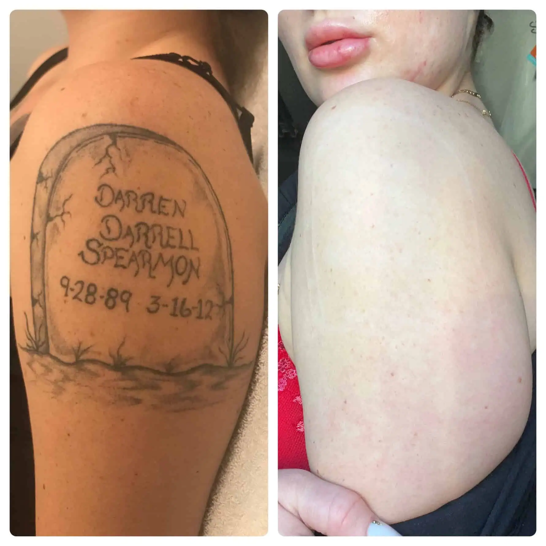 Tattoo Removal Before and After 1 (3)