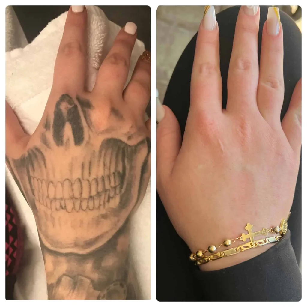 Before and after of tattoo removal on a hand showing faded skull tattoo and clear skin after treatment.